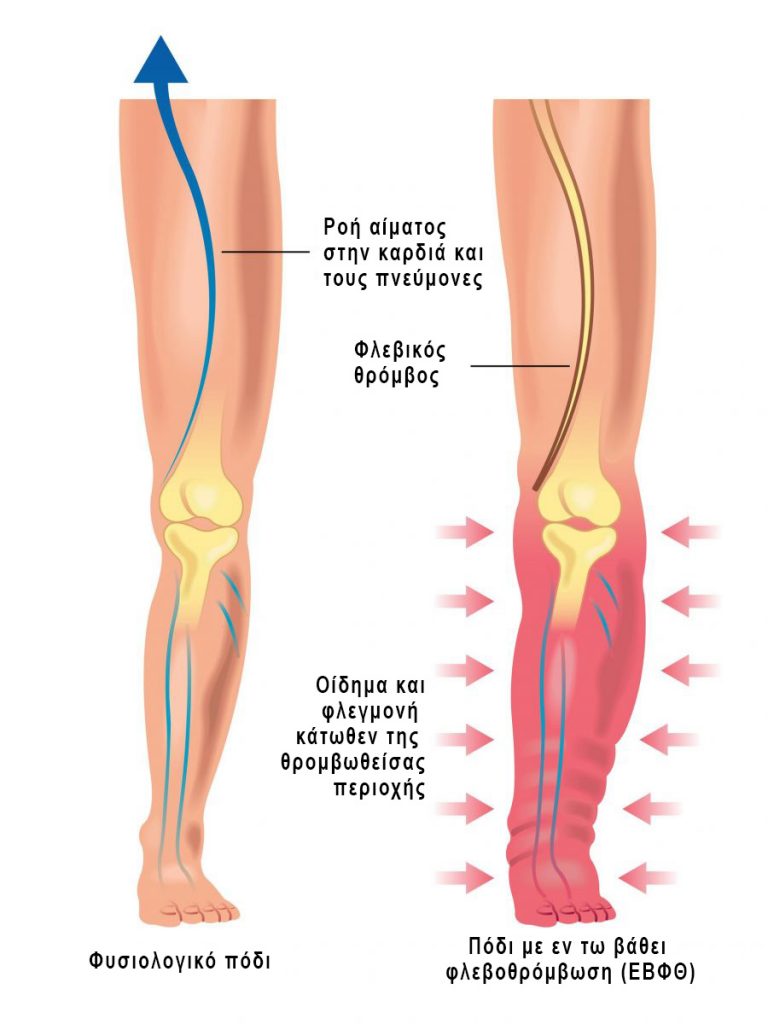 Θρόμβωση μηριαία φλέβα